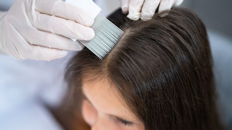 How Do You Check Yourself For Head Lice At Home?