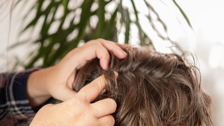 Why Lice Cases Climb When the School Year Starts