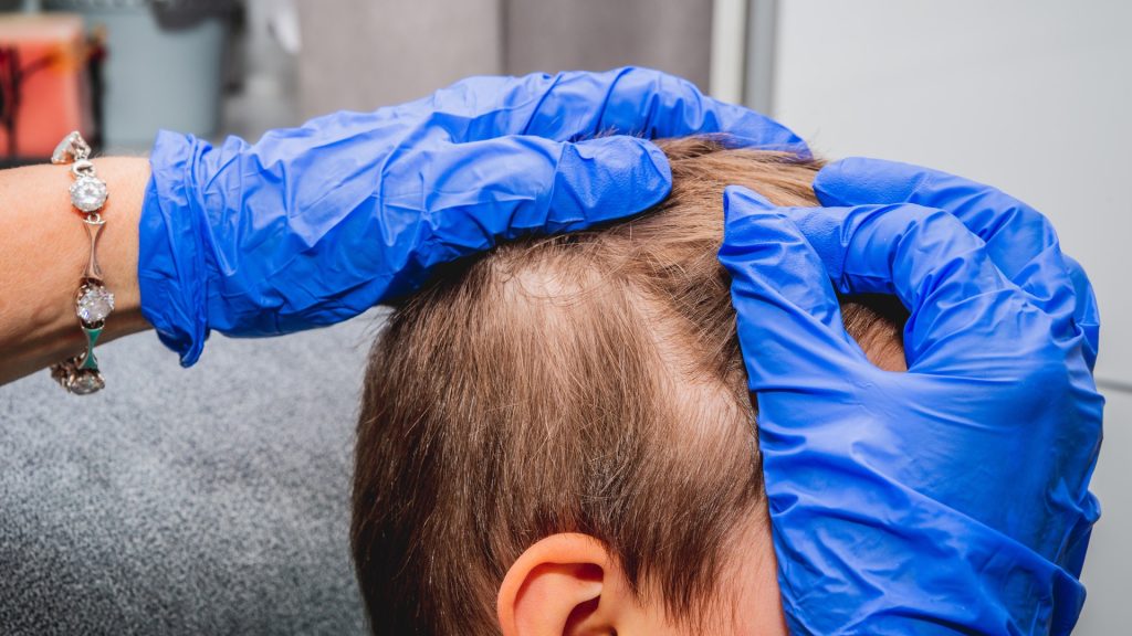 Why Not Every Bump On Your Child’s Scalp Is A Lice Nit?