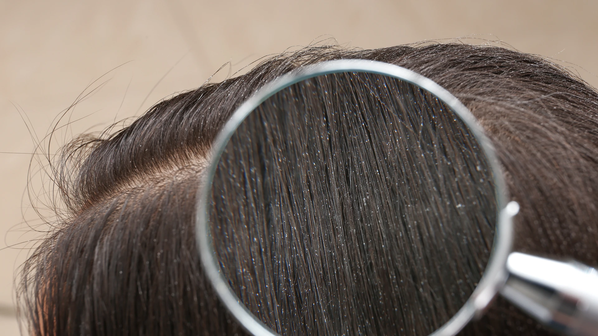 Magnifying glass over dark hair showing small white flecks